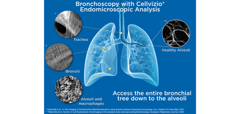 Bronchoscopy with Cellvizio.png
