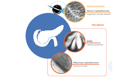 Pancreatic Cyst Patient Website