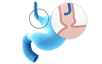 Une nouvelle étude clinique démontre que Cellvizio® permet une meilleure identification des patients à risque de développer un cancer de l’œsophage que le diagnostic standard actuel
