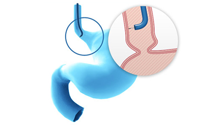 Cellvizio® Demonstrates Superior Identification of Patients at Risk for Esophageal Cancer Compared to Current Diagnostic Standard