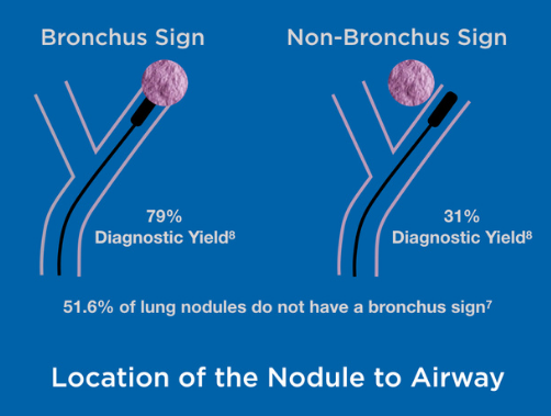 lung-nodules