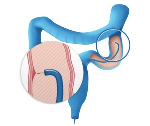 inflammatory bowel diseases